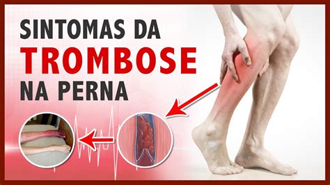 sintomas trombose-1